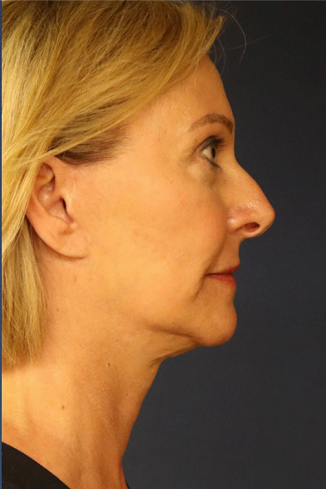 female brow lift facelift blepharoplasty after